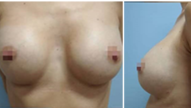 Пластика груди: фото 2 после