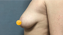 Пластика груди: фото 13 до
