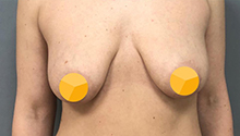 Якорная подтяжка груди: фото 14 до