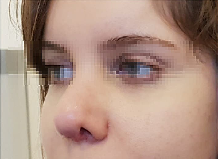 Удаление горбинки носа: фото 2 после