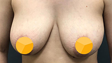 Способы увеличения груди: фото 11 до