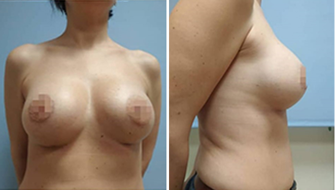 Способы увеличения груди: фото 7 после