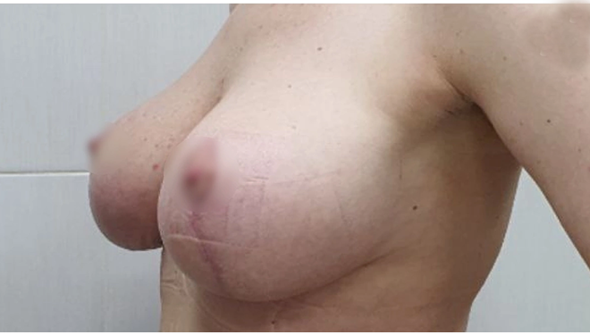 Якорная подтяжка груди: фото 6 после