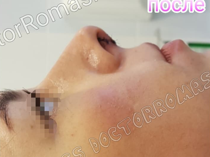 Ринопластика кончика носа: фото 4 после