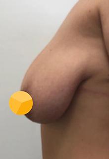 Подтяжка груди: фото 10 до