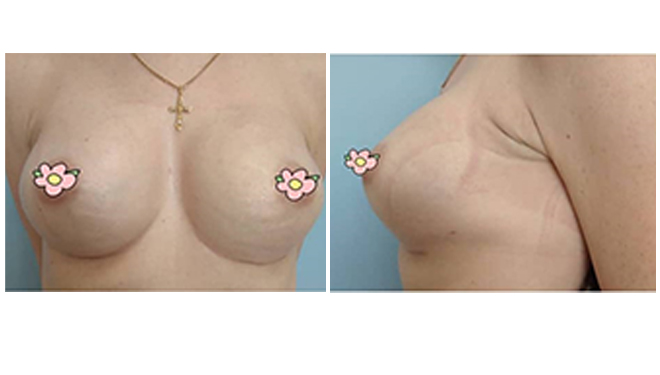 Способы увеличения груди: фото 9 после