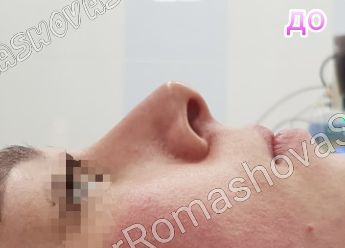 Ринопластика кончика носа: фото 4 до