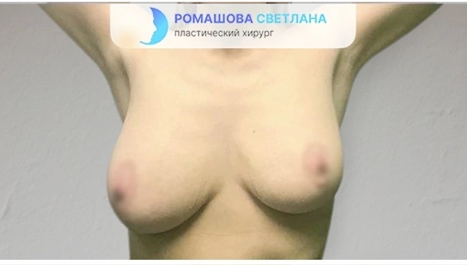 Подтяжка груди: фото 6 до