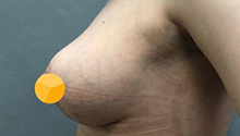 Подтяжка груди: фото 8 после