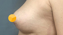 Якорная подтяжка груди: фото 13 после