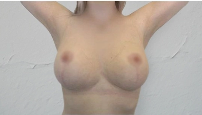 Подтяжка груди: фото 6 после