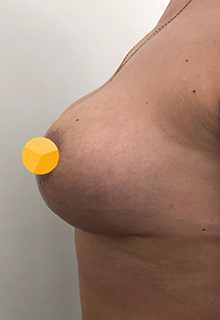 Подтяжка груди: фото 10 после