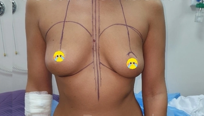 Способы увеличения груди: фото 6 до