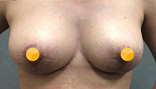 Подтяжка груди: фото 9 после