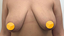 Якорная подтяжка груди: фото 10 до