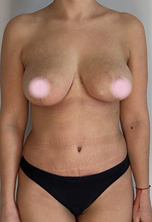 Якорная подтяжка груди: фото 9 после