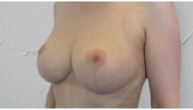 Якорная подтяжка груди: фото 5 после