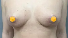 Уменьшение груди: фото 11 после