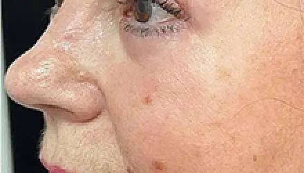 Верхняя блефаропластика: фото 11 после