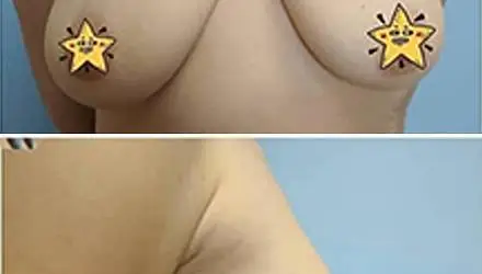 Уменьшение груди: фото 1 до