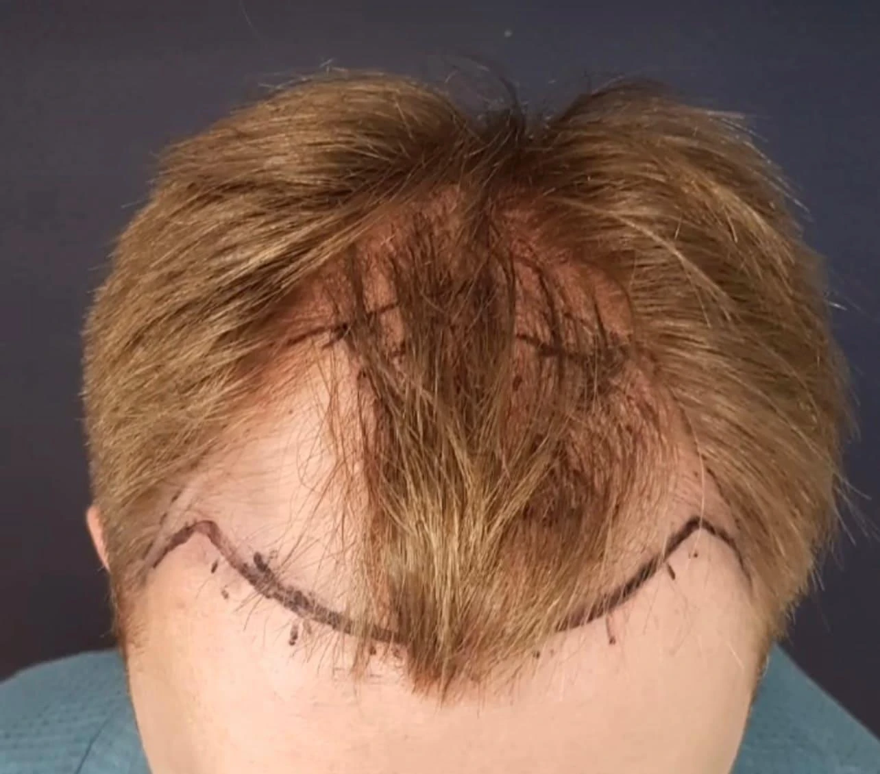 Пересадка волос при сенильной алопеции: фото 4 до