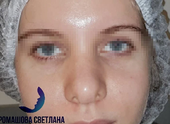 Коррекция кончика носа: фото 3 до