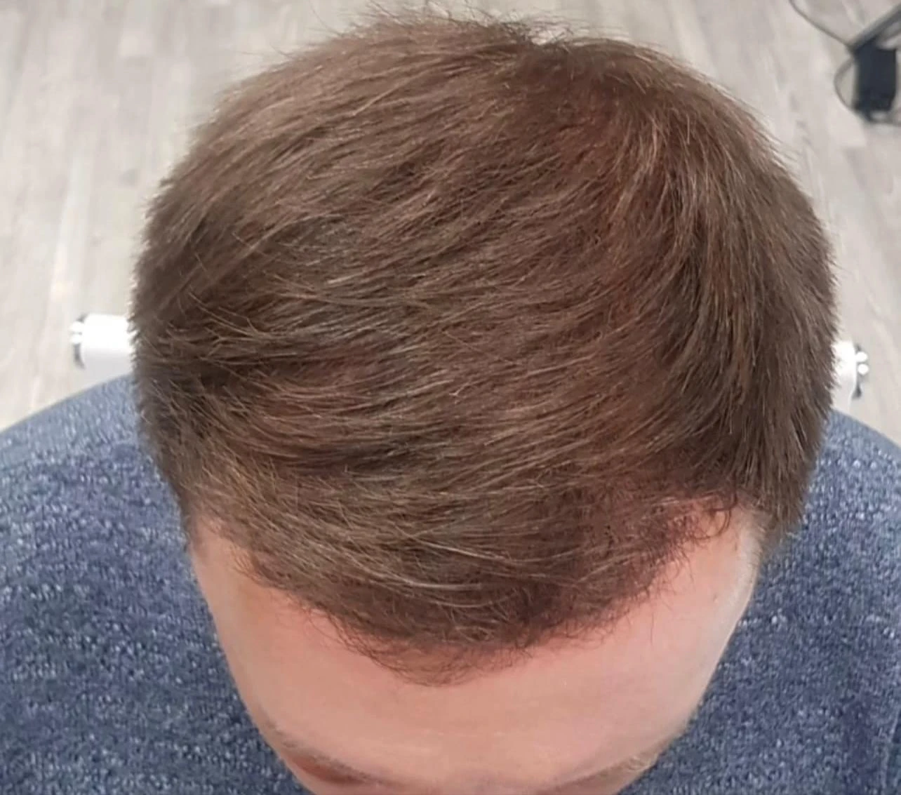 Пересадка волос при сенильной алопеции: фото 4 после