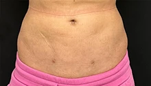 Липосакция: фото 4 после