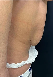 Операция по липосакции живота: фото 8 до