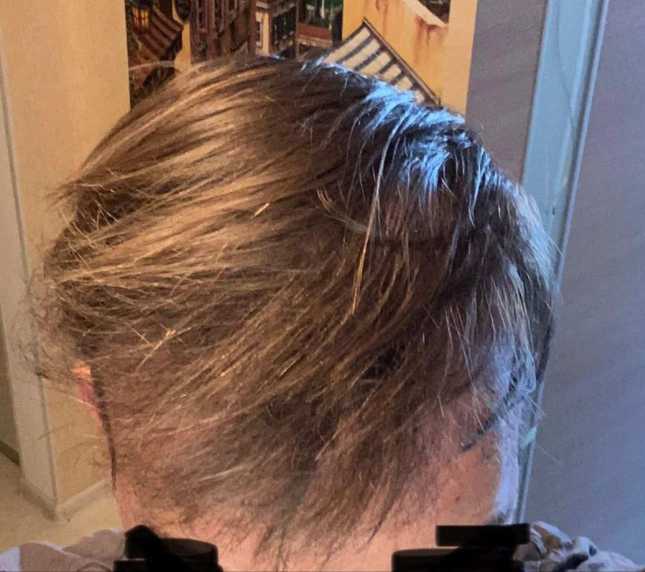 Пересадка волос при сенильной алопеции: фото 5 после