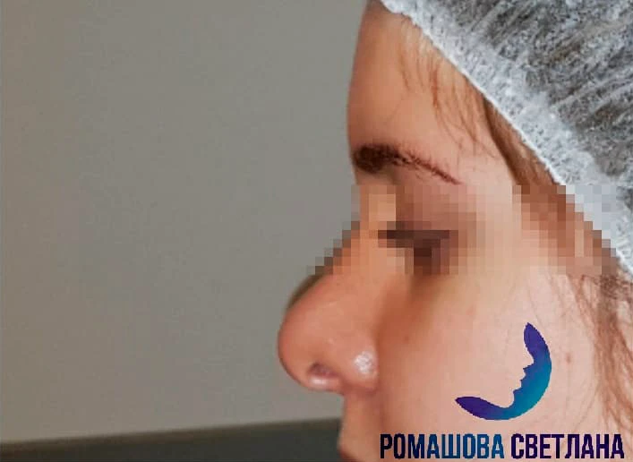 Коррекция кончика носа: фото 1 до