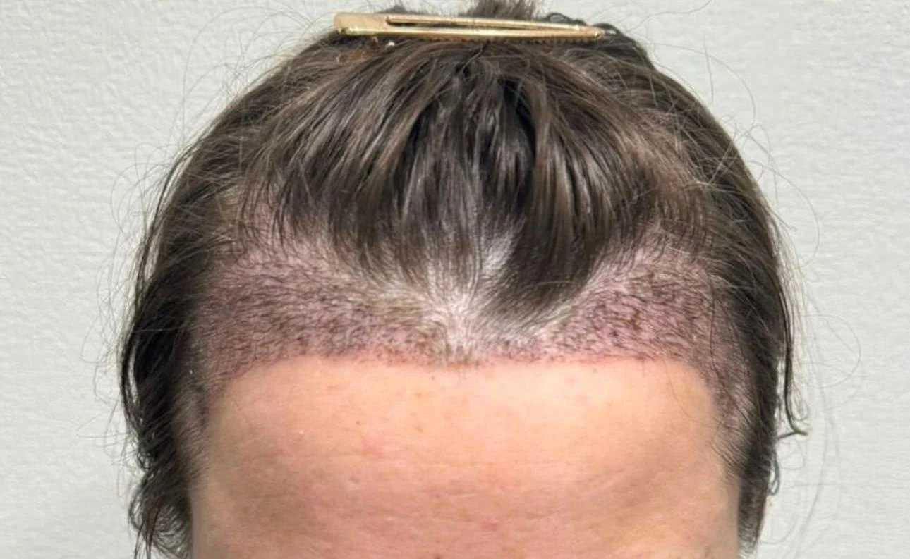 Пересадка волос при сенильной алопеции: фото 6 после