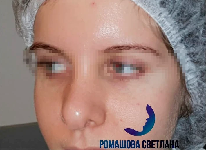 Коррекция кончика носа: фото 2 до