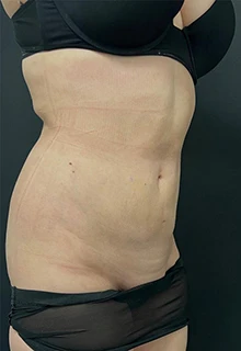 Липосакция: фото 3 после