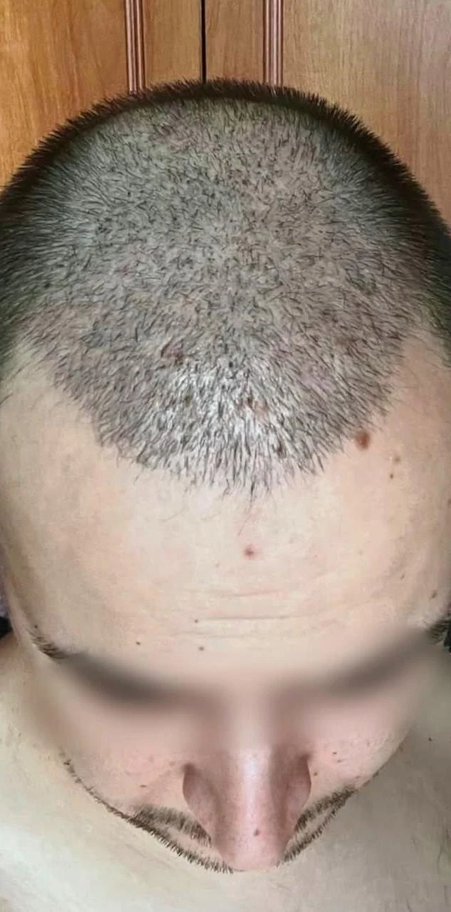 Пересадка волос при сенильной алопеции: фото 8 после