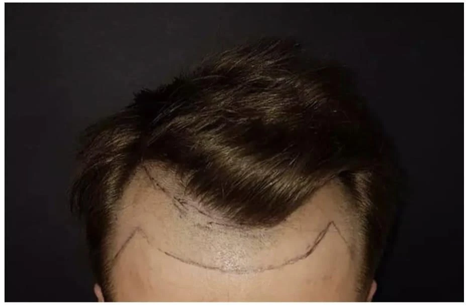 Пересадка волос при сенильной алопеции: фото 1 до