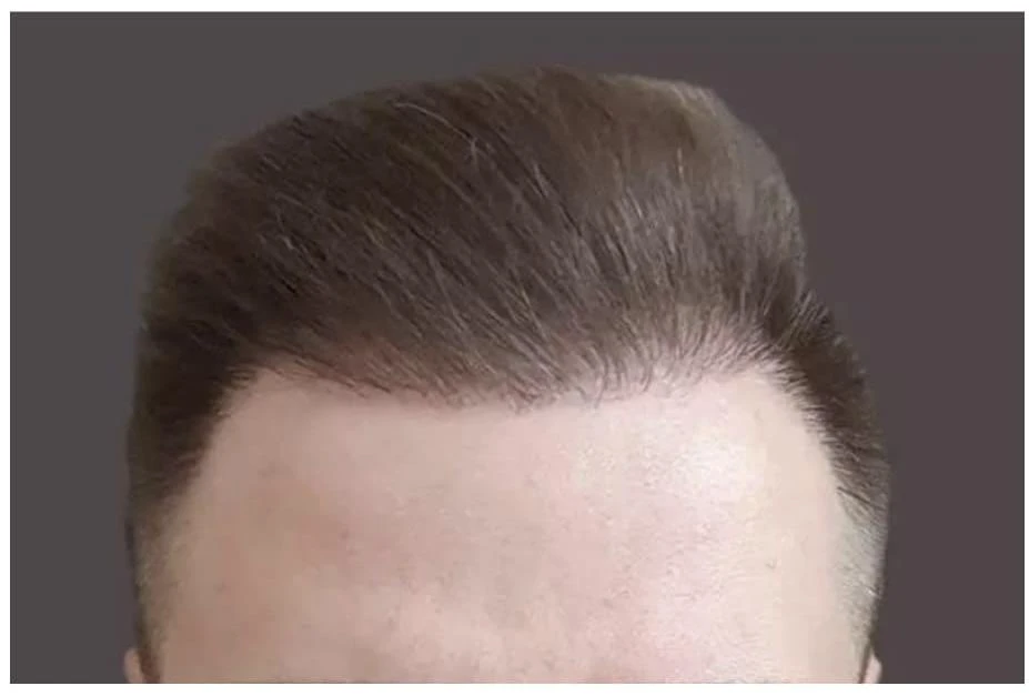 Пересадка волос при сенильной алопеции: фото 1 после