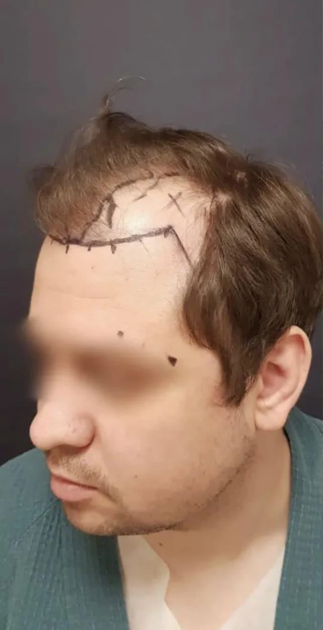 Пересадка волос при сенильной алопеции: фото 2 до