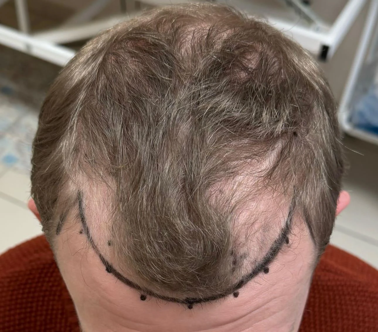 Пересадка волос при сенильной алопеции: фото 9 до