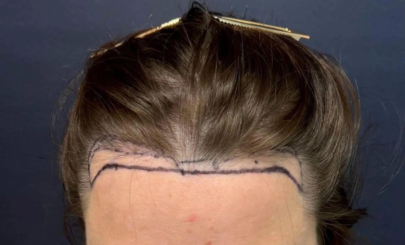 Пересадка волос при сенильной алопеции: фото 6 до