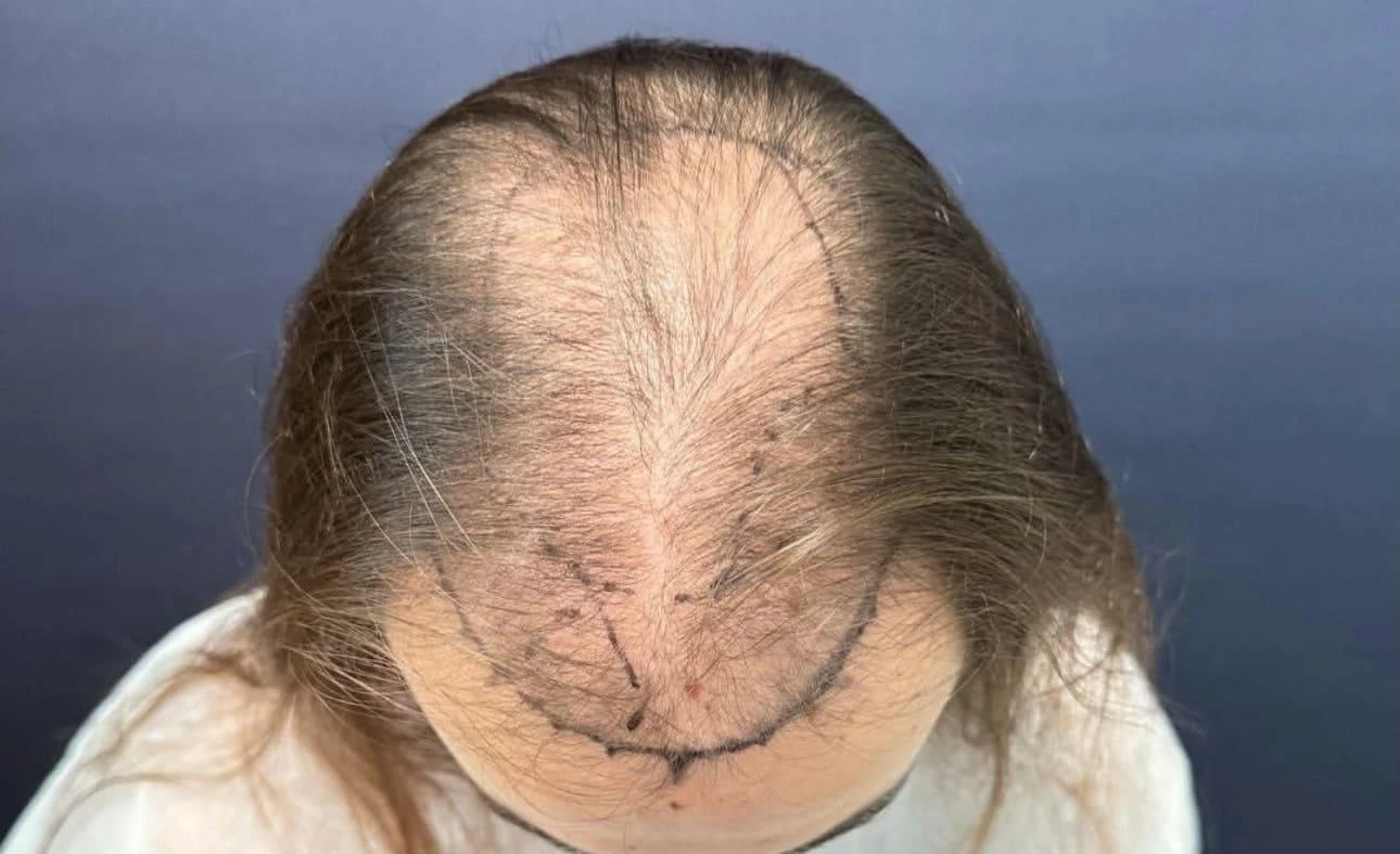 Пересадка волос при сенильной алопеции: фото 10 до