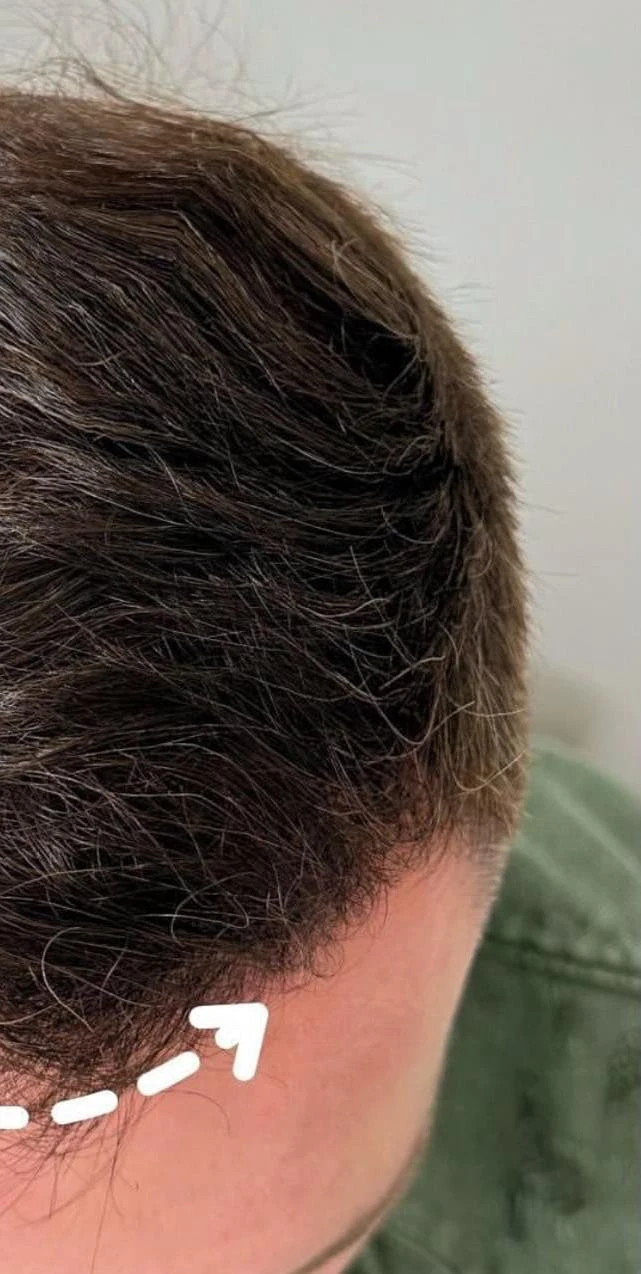 Пересадка волос при сенильной алопеции: фото 7 после