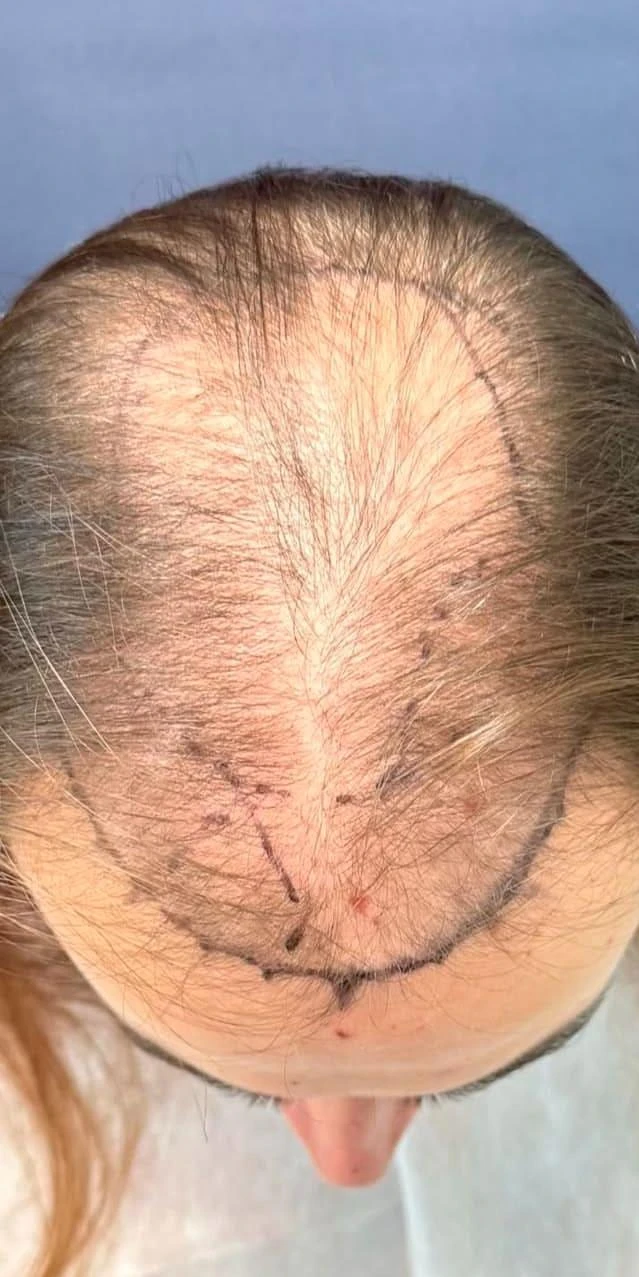 Пересадка волос при сенильной алопеции: фото 8 до