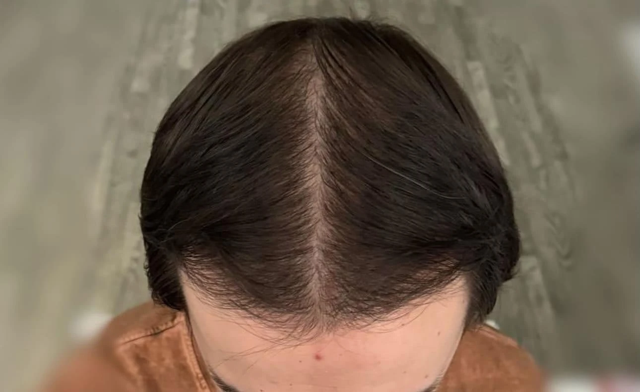 Пересадка волос при сенильной алопеции: фото 10 после