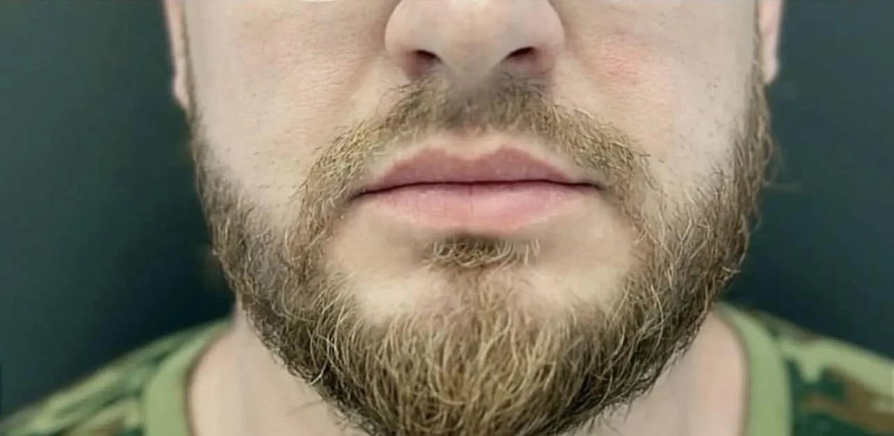 Пересадка волос при сенильной алопеции: фото 3 после