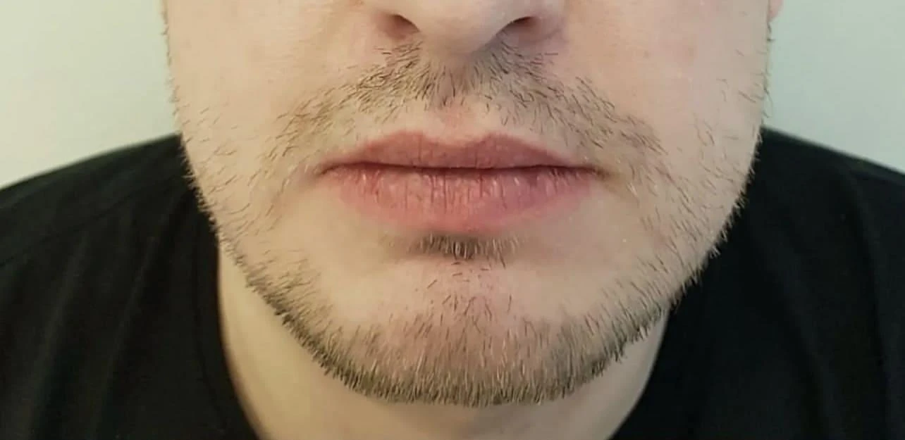 Пересадка волос при сенильной алопеции: фото 3 до