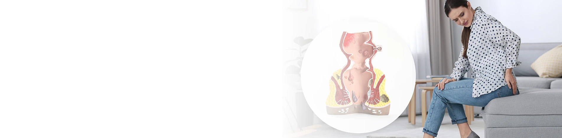 Геморроидальные узлы