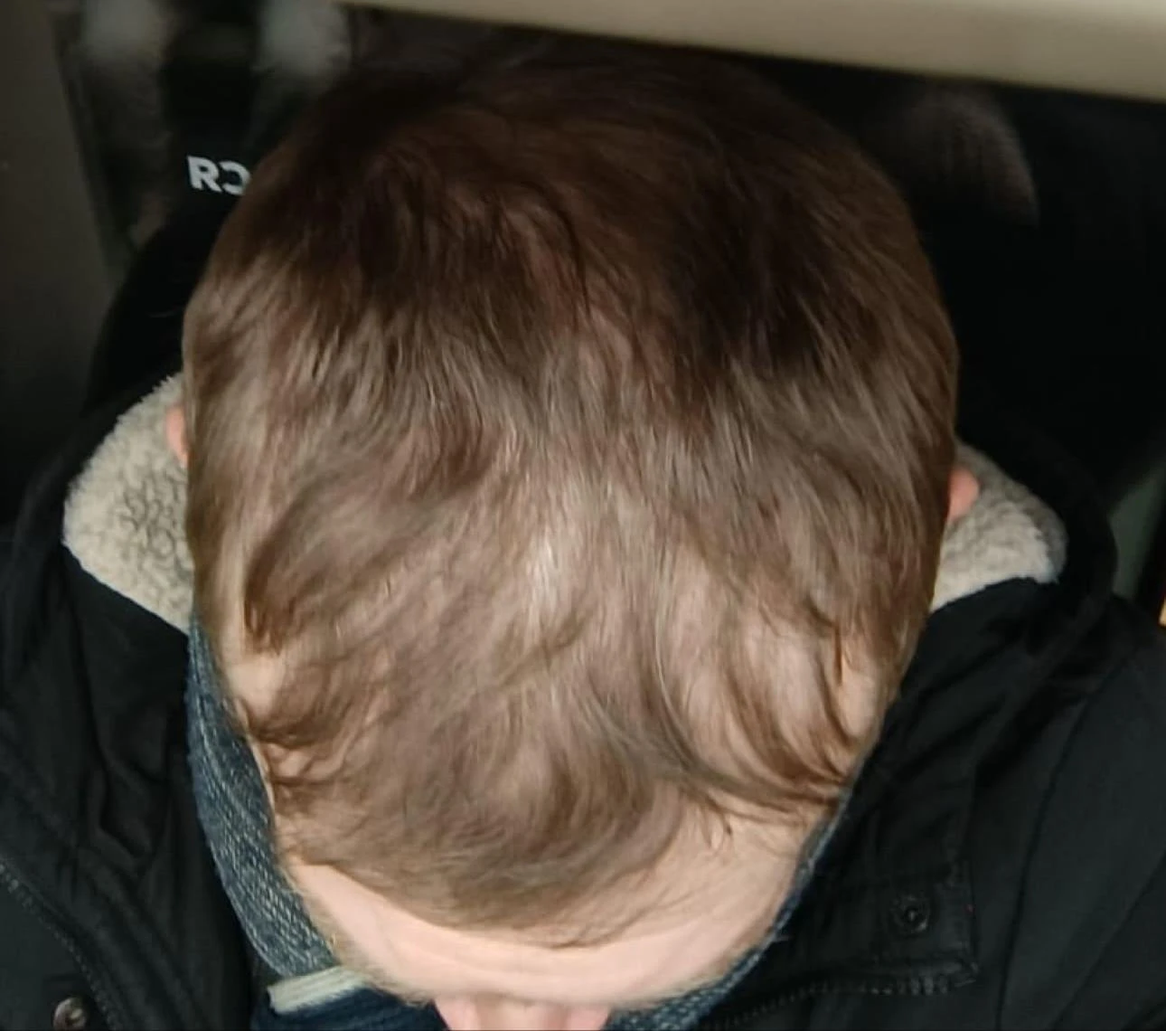 Пересадка волос при сенильной алопеции: фото 9 после