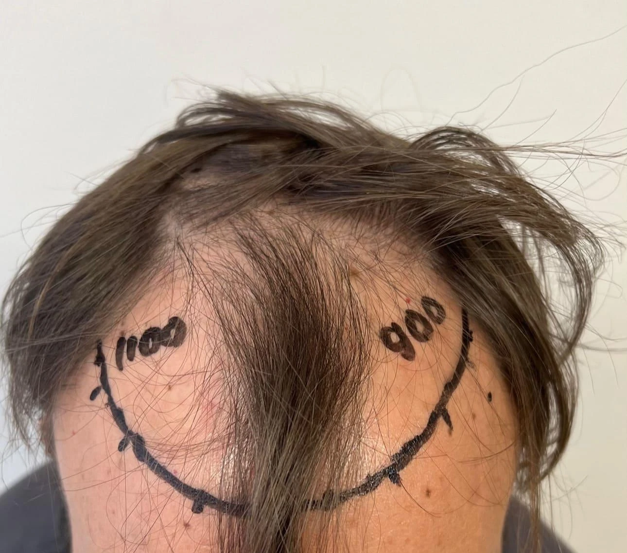 Пересадка волос при сенильной алопеции: фото 5 до