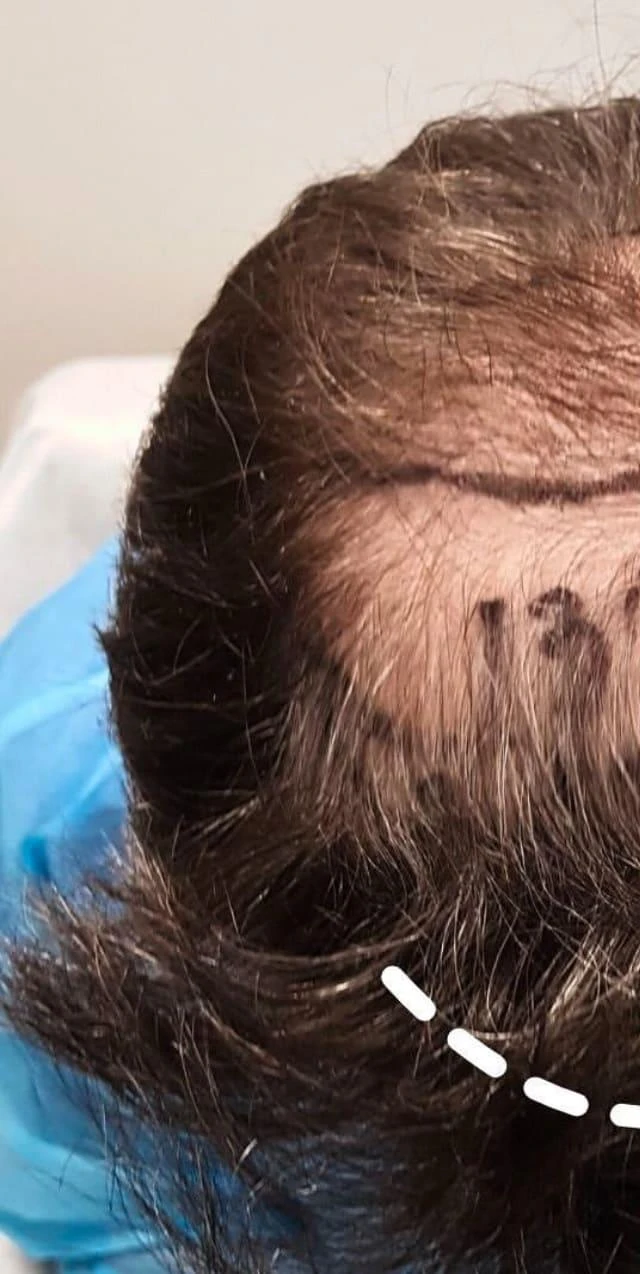 Пересадка волос при сенильной алопеции: фото 7 до